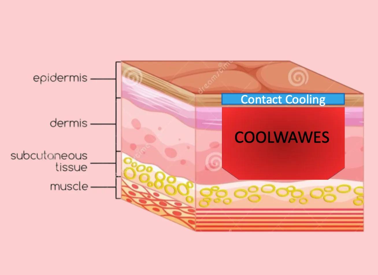 專利 Coolwaves™技術