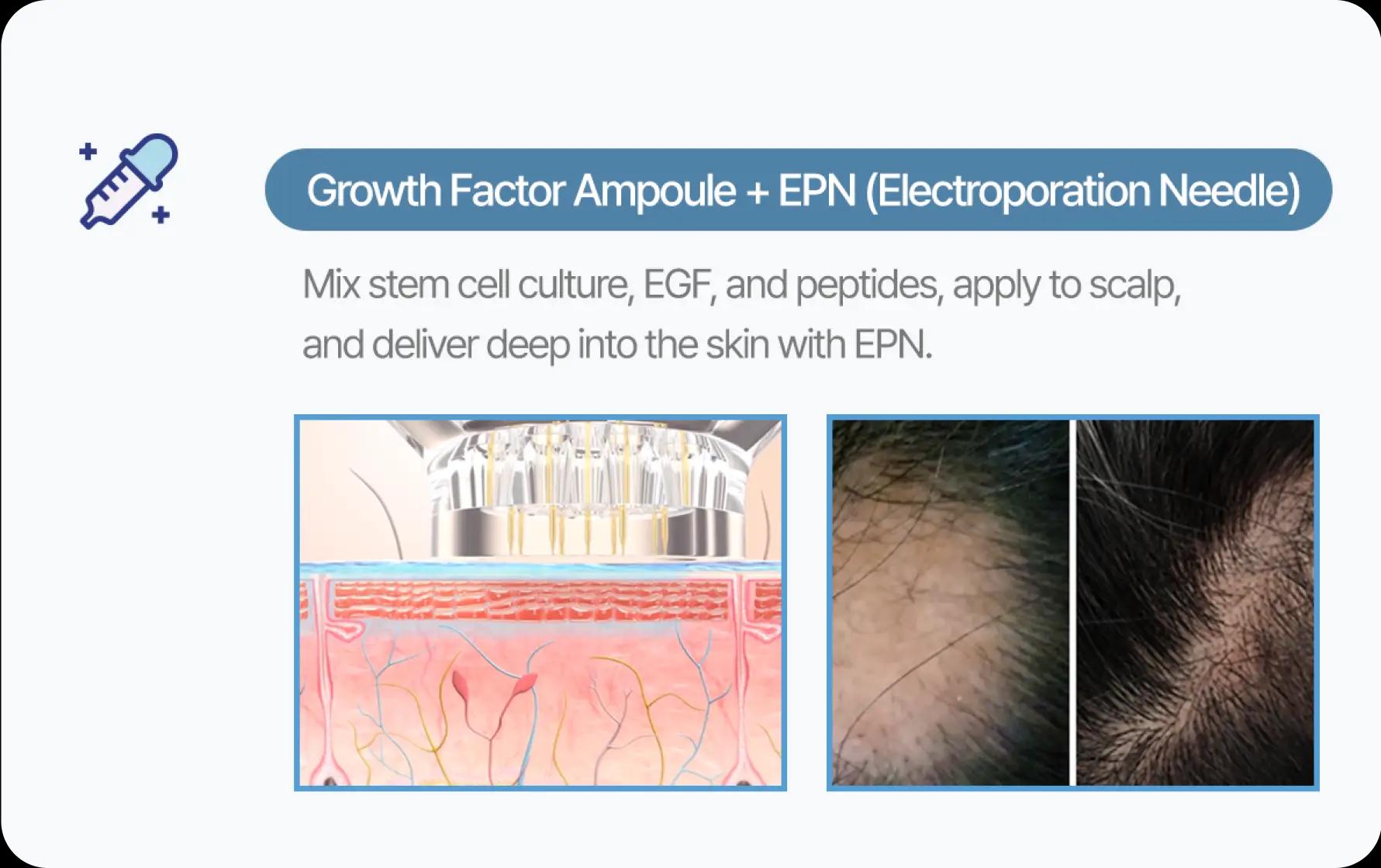 홀드 탈모치료 프로그램 2