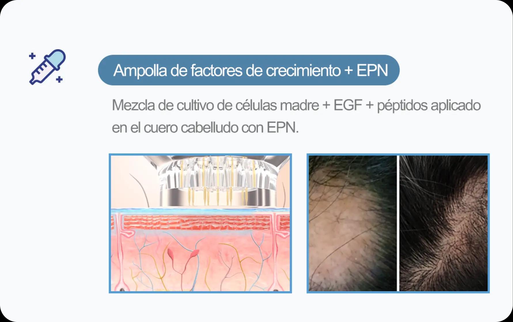 홀드 탈모치료 프로그램 3