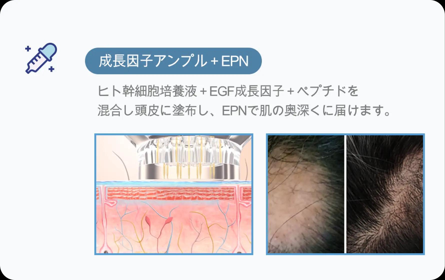 홀드 탈모치료 프로그램 3