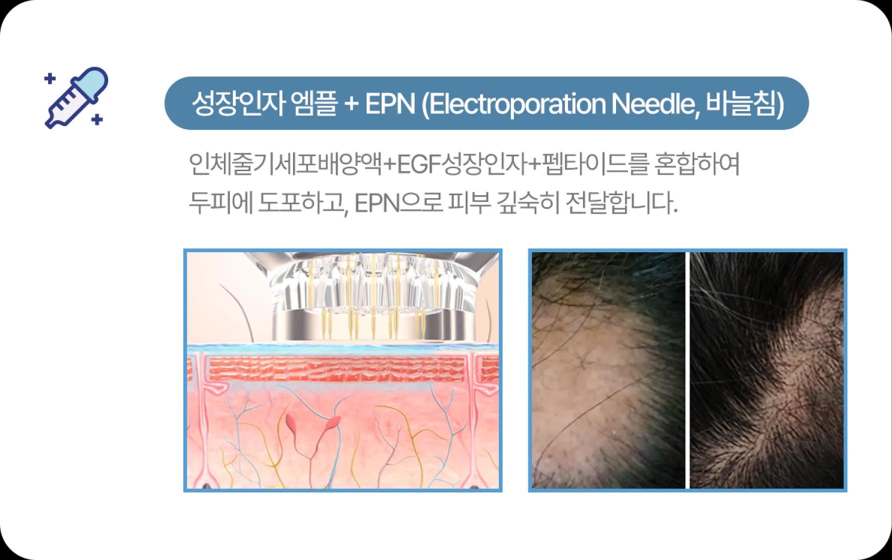 홀드 탈모치료 프로그램 3