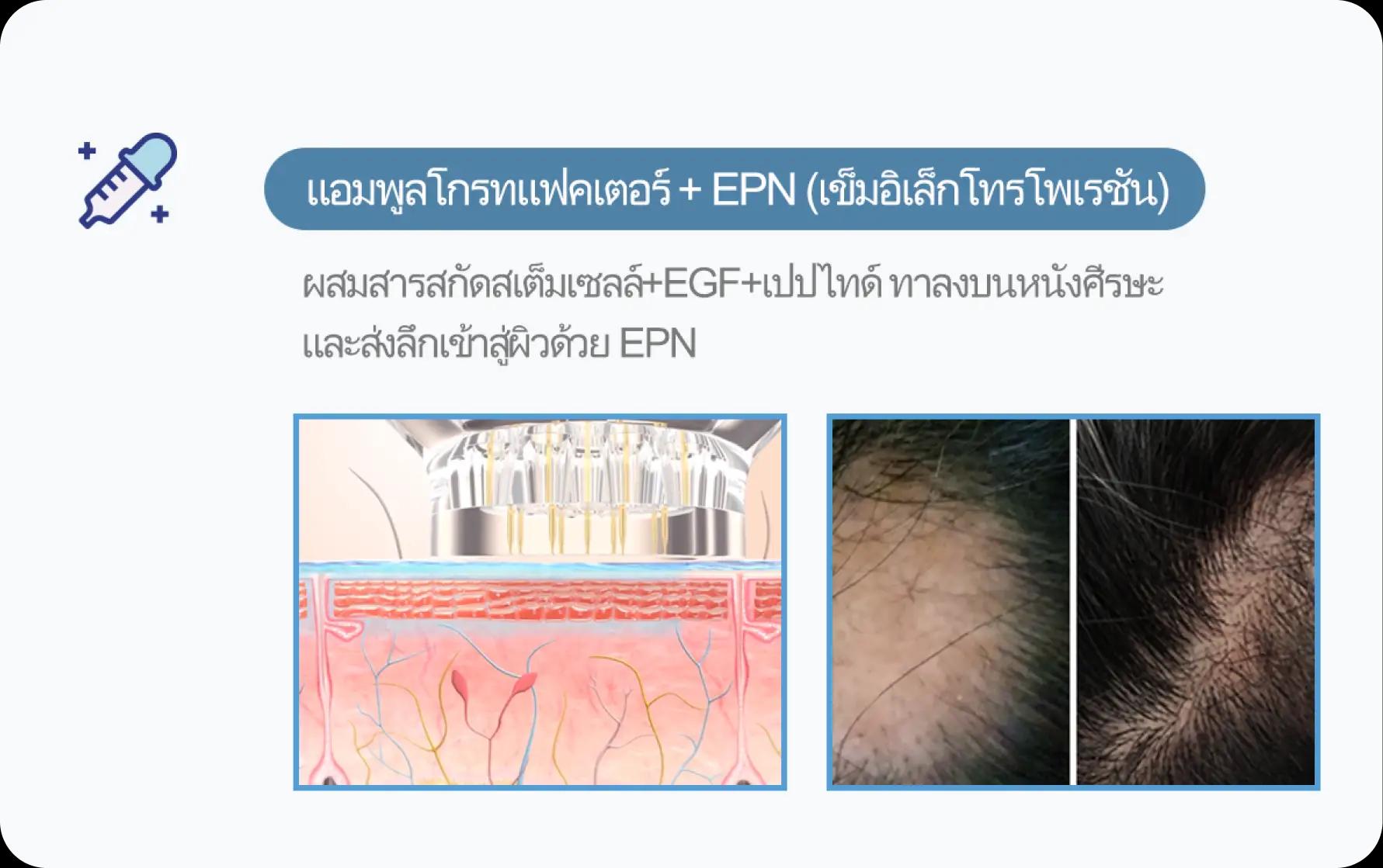 홀드 탈모치료 프로그램 3