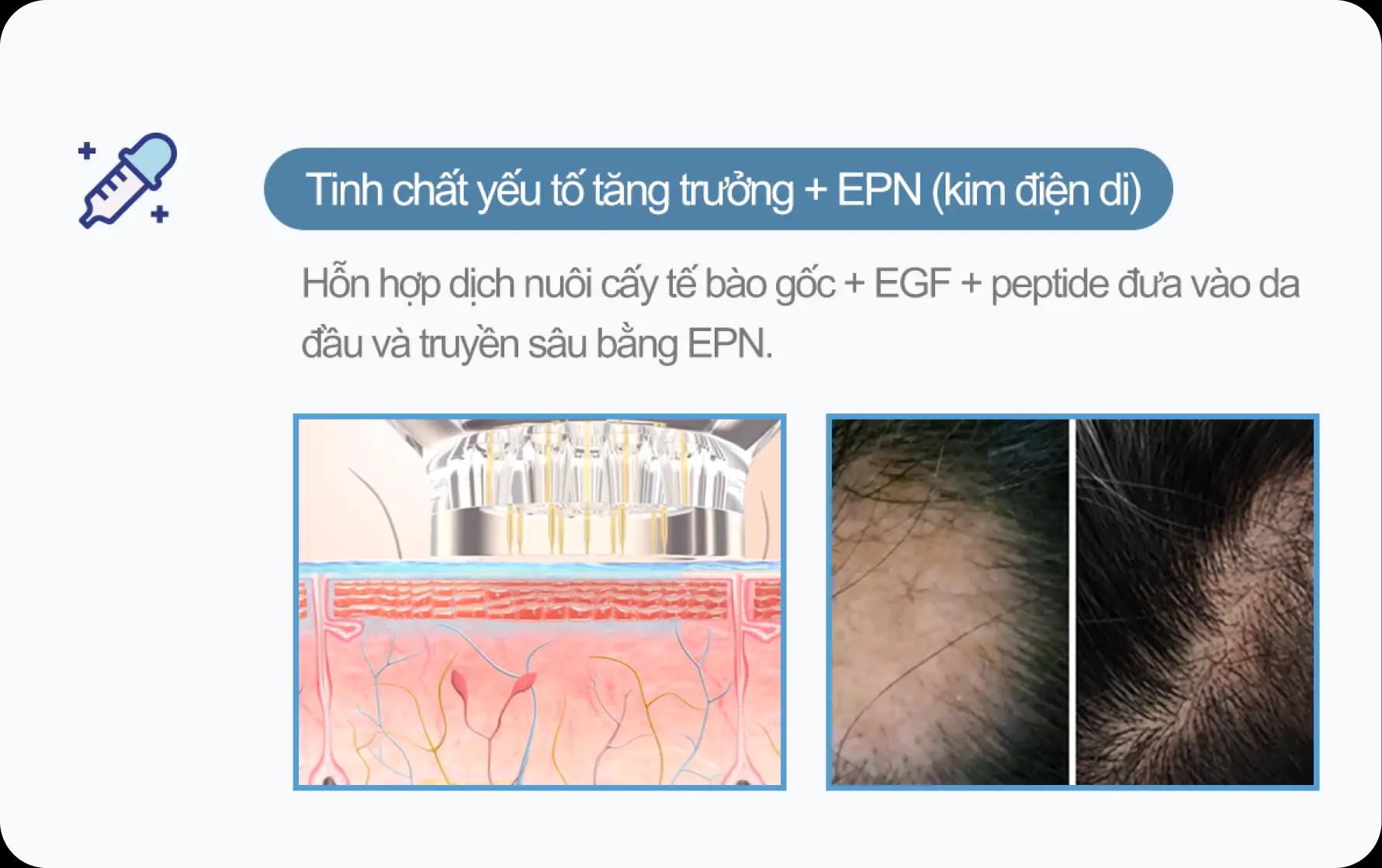 홀드 탈모치료 프로그램 3