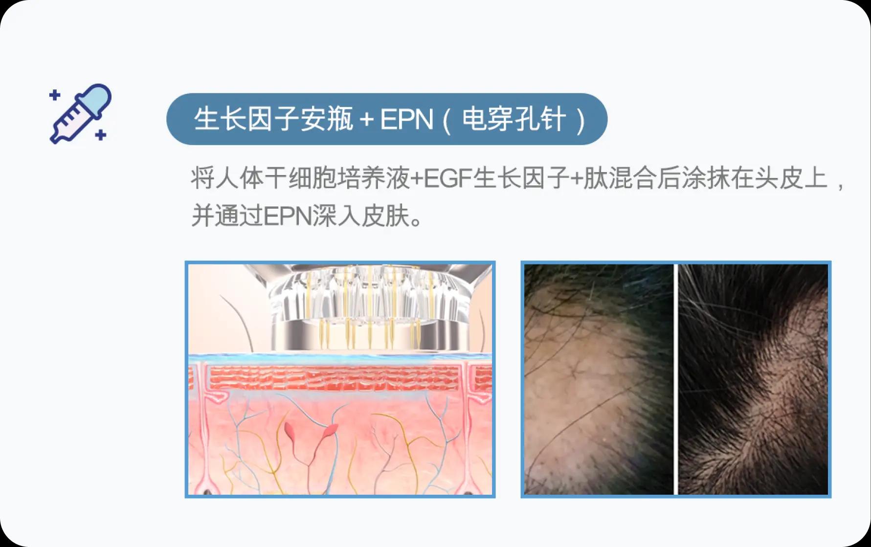 홀드 탈모치료 프로그램 3