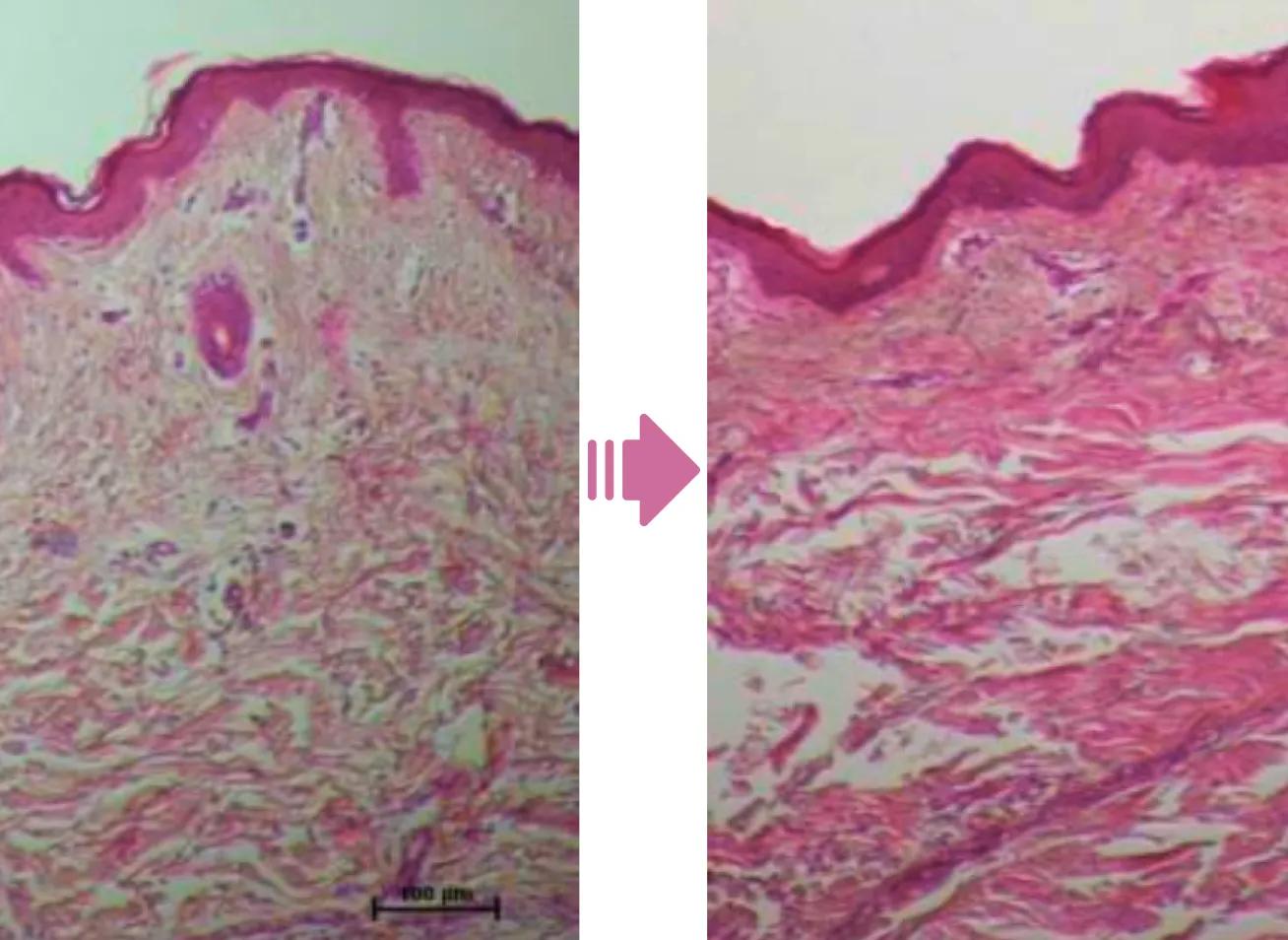 即効のタイトニング＆長期のリフティング