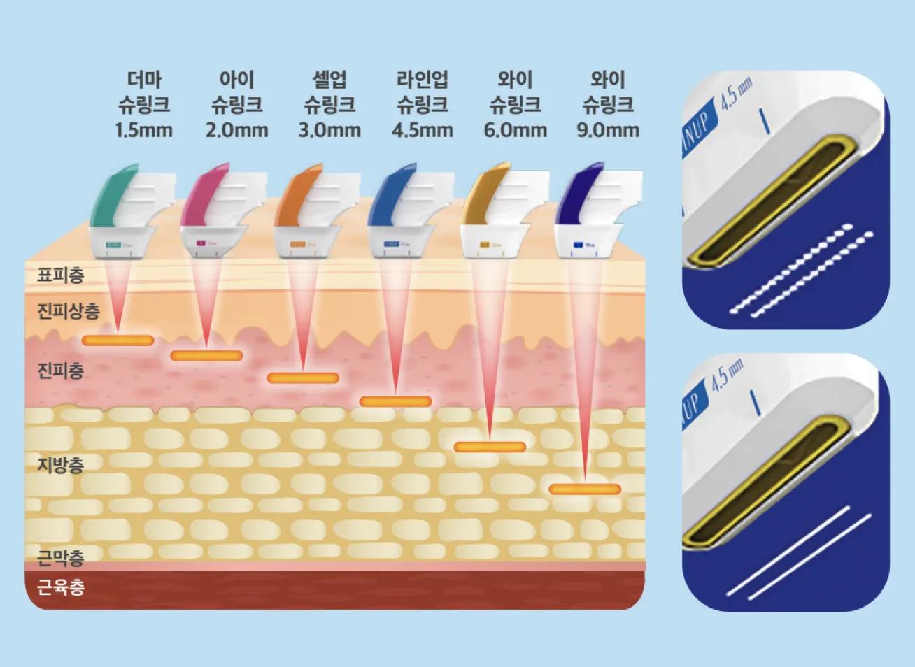 ¡Primero en el mundo! Manípulo estilo bolígrafo 'Ultra F'
