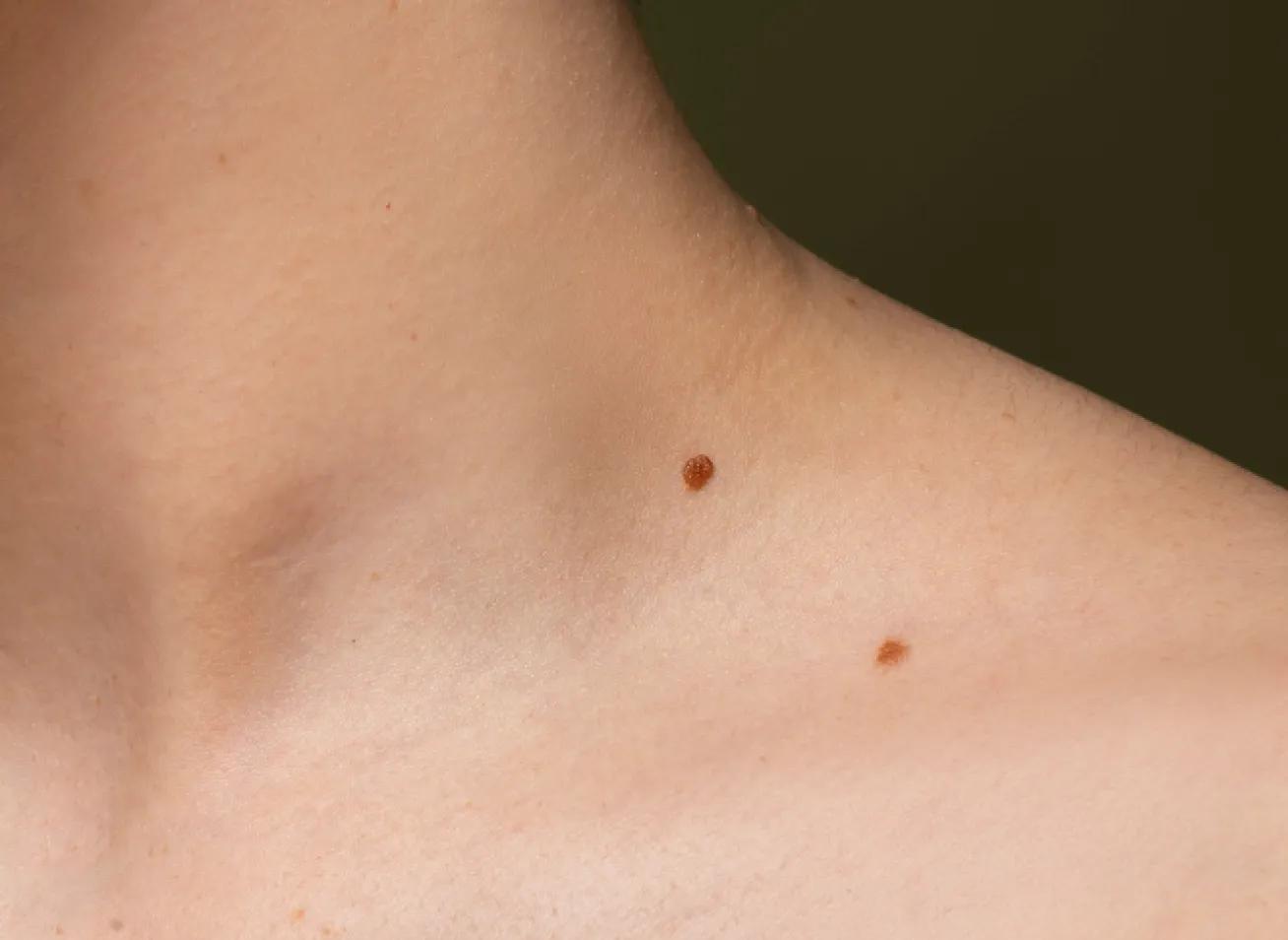 Penetrasi kuat pada panjang gelombang 10.600nm